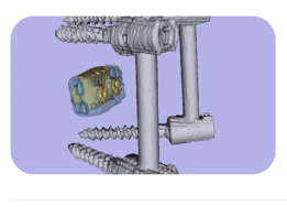 Three-dimensional reconstruction of an interbody fusion cage seated between instrumented vertebral bodies