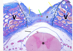 Annotated decalcified histological section through a motion segment, with vertebrae and neural structures marked