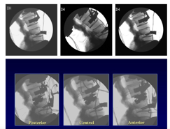 A series of fluoroscopic images of an implant shown in posterior, neutral and anterior positions