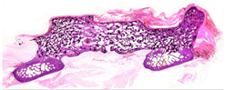 Haematoxylin and eosin stained section through a posterolateral fusion mass
