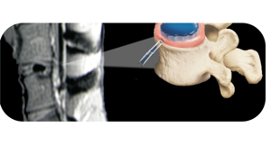 Illustration of a lumbar motion segment with instruments entering the disc space