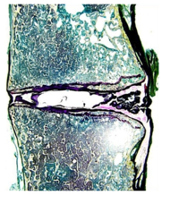 Stained histological section through a motion segment following a neuroplasty procedure