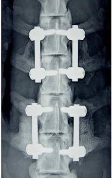 Anteroposterior plain film radiograph of a two-level instrumented construct