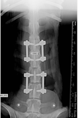 Anteroposterior plain film radiograph of an instrumented lumbar construct with a measurement scale