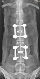 Anteroposterior plain film radiograph of a two-level instrumented lumbar construct
