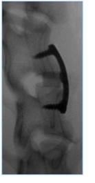 Lateral plain film radiograph of an instrumented spinal construct